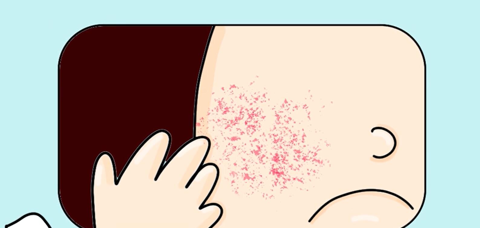 【脂溢性皮炎】起初，我以为那只是一场普通的泛红……